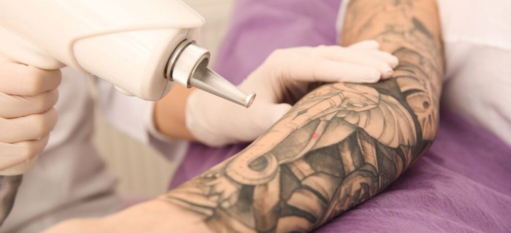 Picosure and Alma Harmony XL Pro lasers used for tattoo removal at Clara Medical Spa in Thornhill