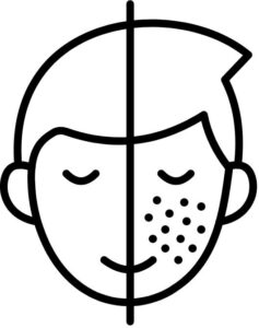 laser-treatment-for-brown-spots-on-face A close-up of a woman's face with white circles highlighting specific brown spots and hyperpigmentation targeted for laser removal.