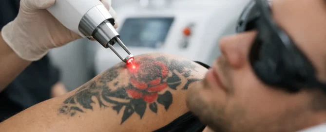 How Does Tattoo Removal Work?